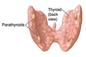 hyperparathyroidism